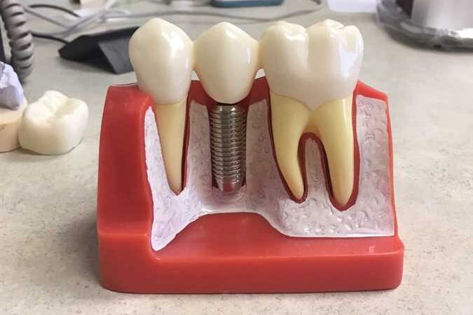 Petrie Storer & Associates Dental Bridge and Dental Implant Informational Series: Implant Bridges